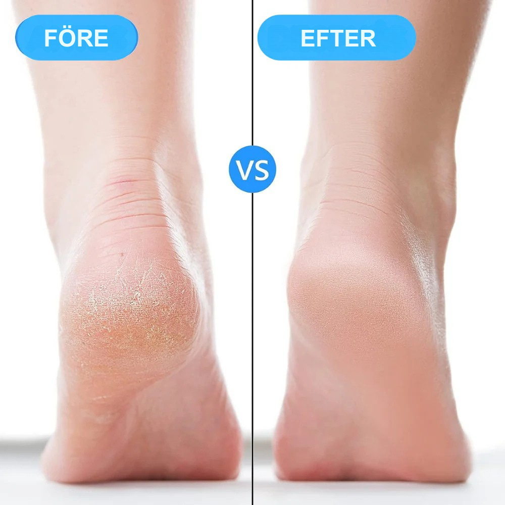 Heelix™ | Lindrar spänningar och lugnar din häl