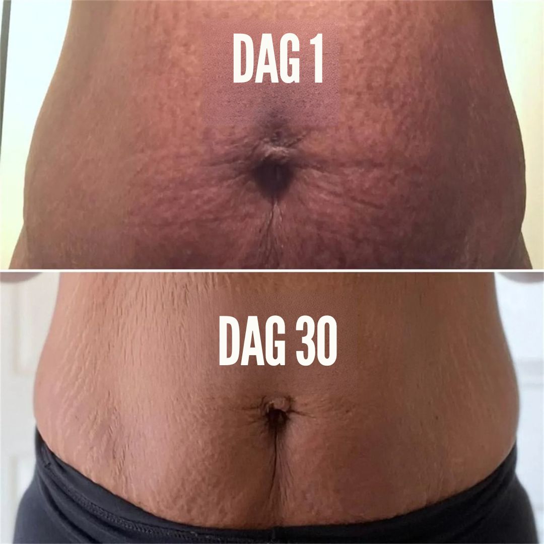 RenewSkin™ | Slät hud utan ärr